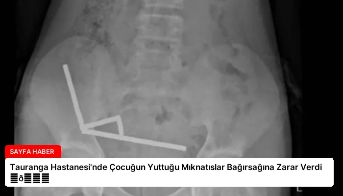 Tauranga Hastanesi’nde Çocuğun Yuttuğu Mıknatıslar Bağırsağına Zarar Verdi ⏬👇